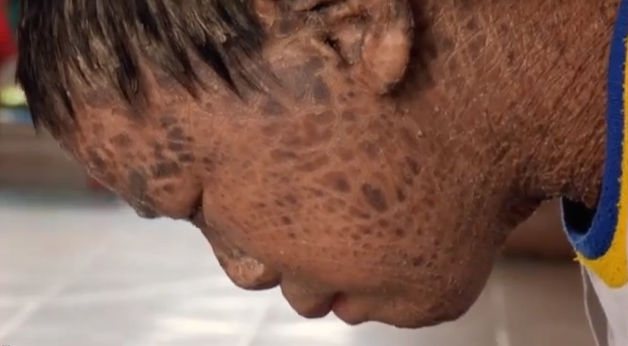 Kina, fiskhud, Fiskpojken, Hud, Sjukdom